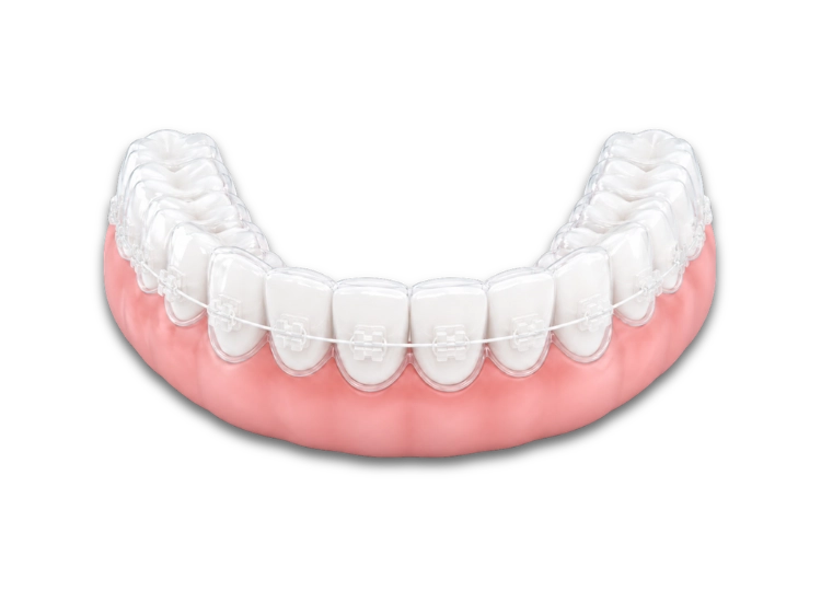 Brackets estéticos en Ibi