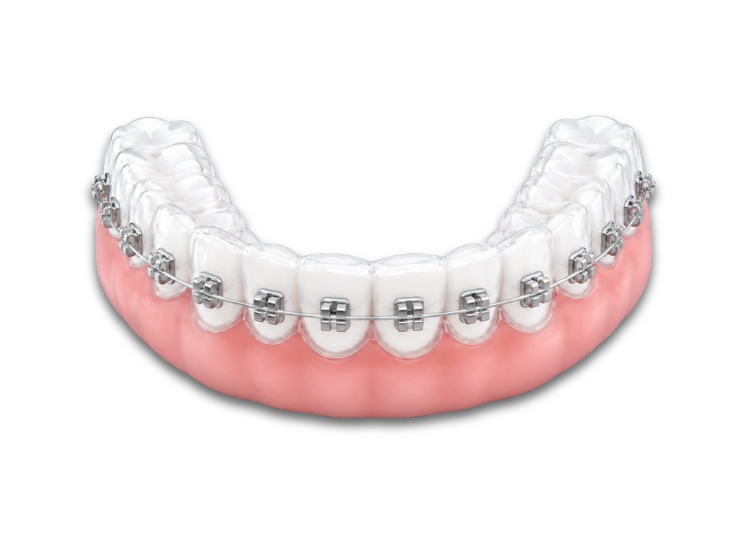 Brackets metálicos en Ibi