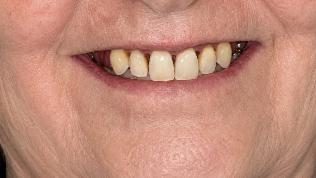 antes implantes dentales caso 1