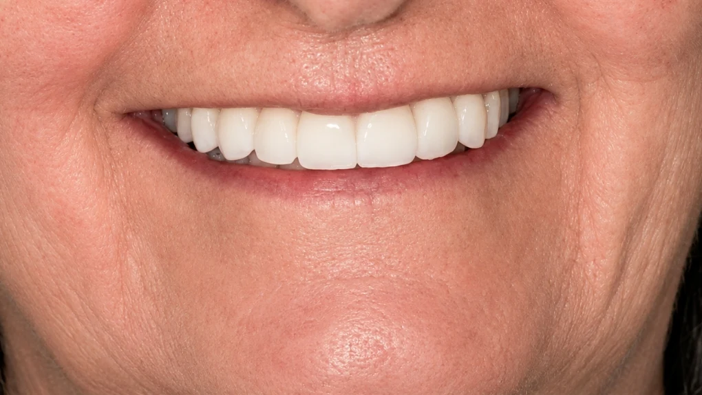 Después implantes dentales caso 1