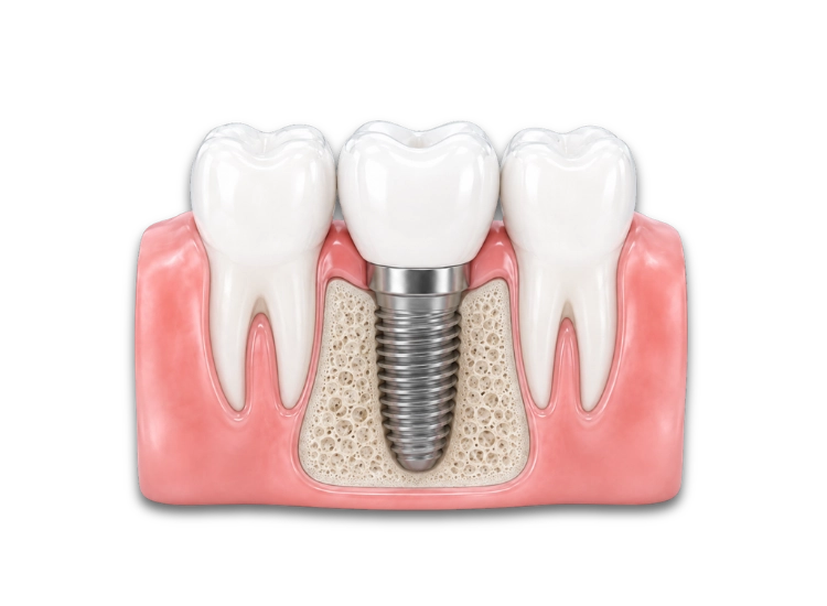 Implante unitario Implante dental unitario