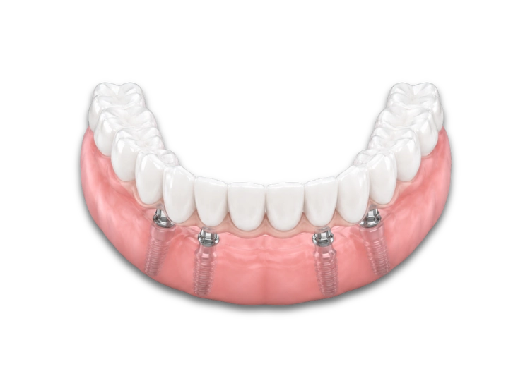 all on 4 y all on 6 implantes all on 4 y all on 6 implantes dentales