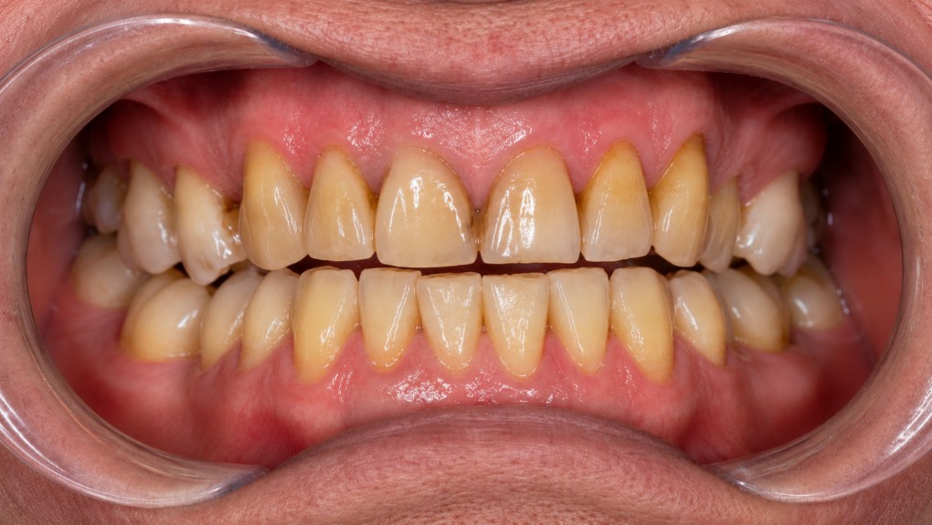 Antes carillas dentales caso 1 - decoloración severa