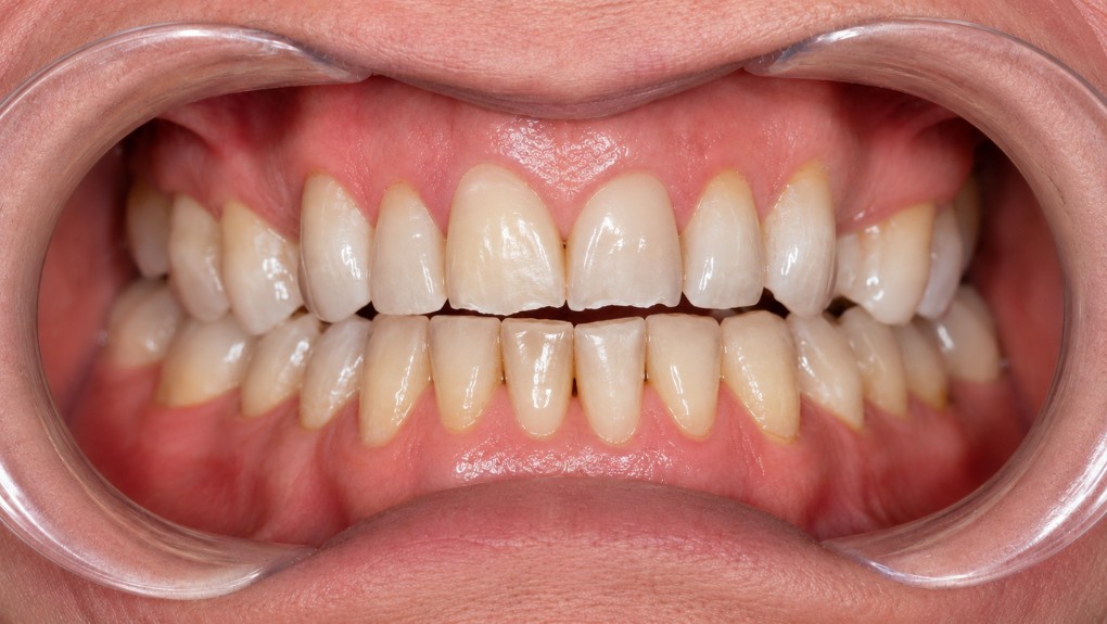 Antes carillas dentales caso 2 - desgaste y decoloración