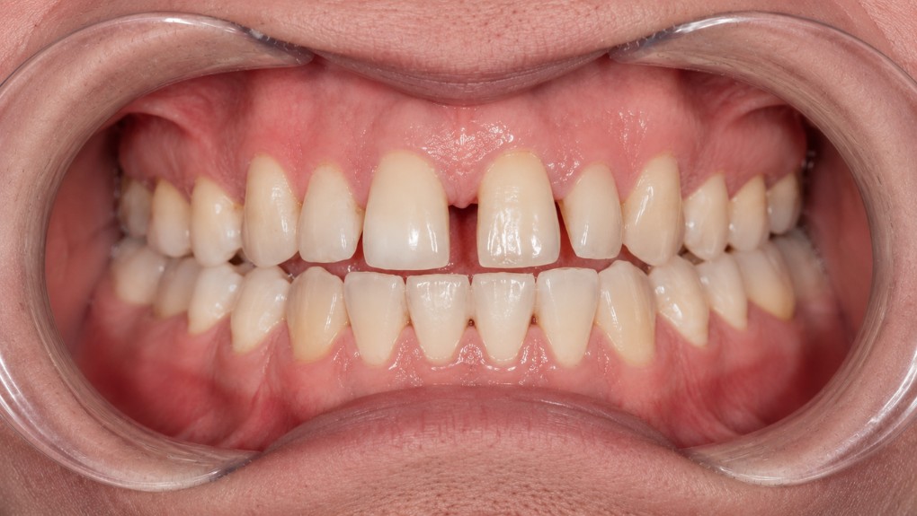 Antes carillas dentales caso 3 - diastema