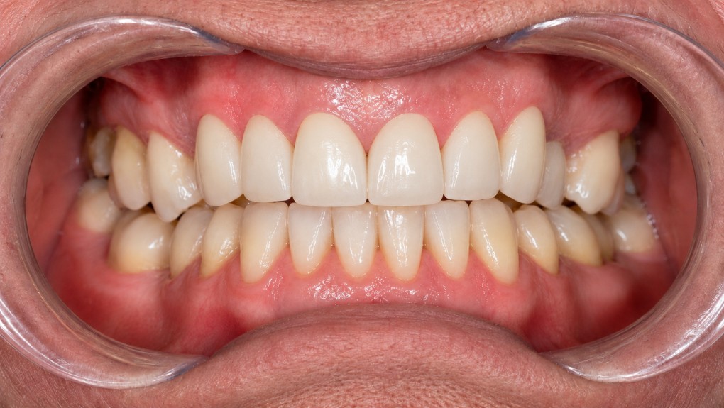 Después carillas dentales caso 1 - cambio de color completo
