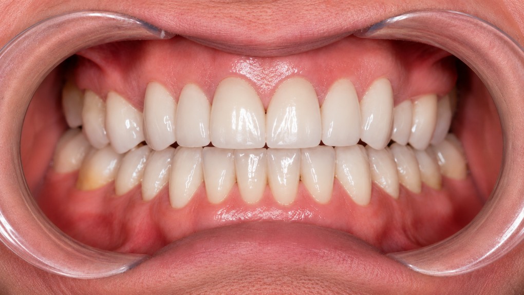 Después carillas dentales caso 2 - rehabilitación estética