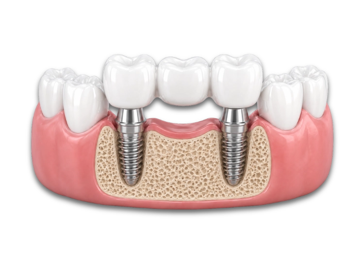 puente dental puente dental en implantología