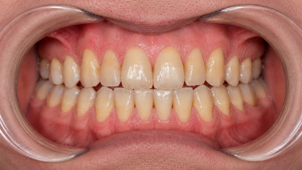 Antes blanqueamiento dental caso 2