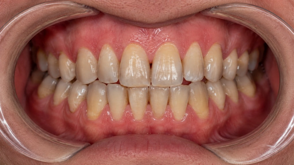 Antes blanqueamiento dental caso 3