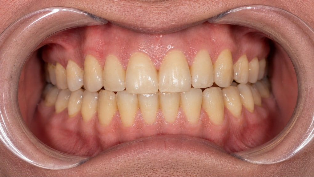 Antes blanqueamiento dental caso 1
