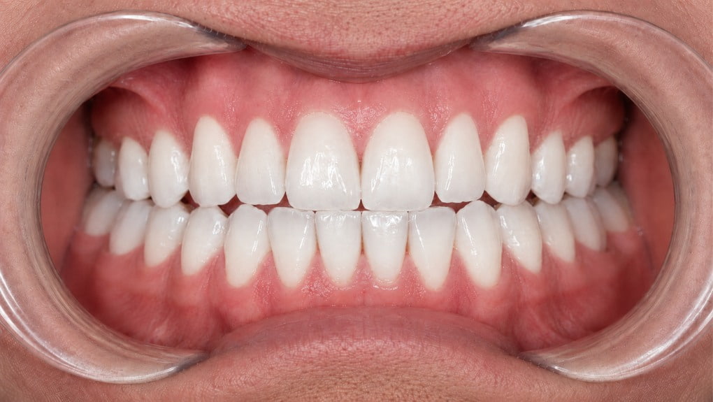 Después blanqueamiento dental caso 2