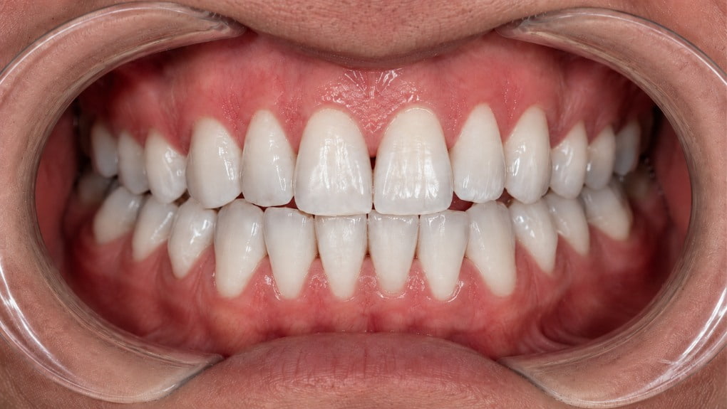 Después blanqueamiento dental caso 3
