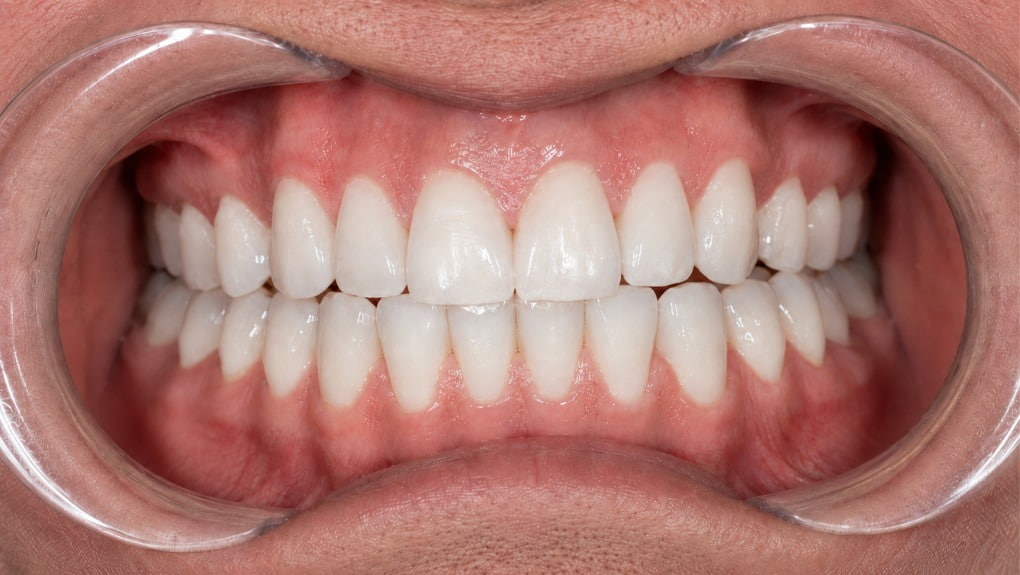 Después blanqueamiento dental caso 1