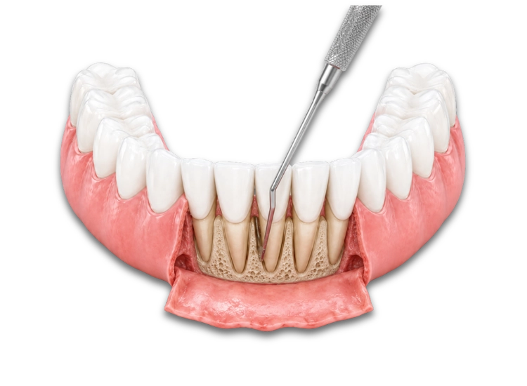 Cirugía periodontal