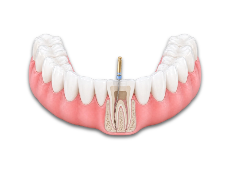 endodoncia convencional