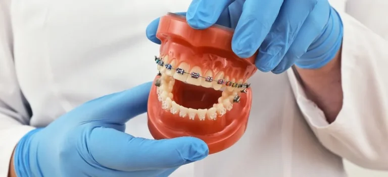 Modelo dental con brackets metálicos durante un tratamiento de ortodoncia