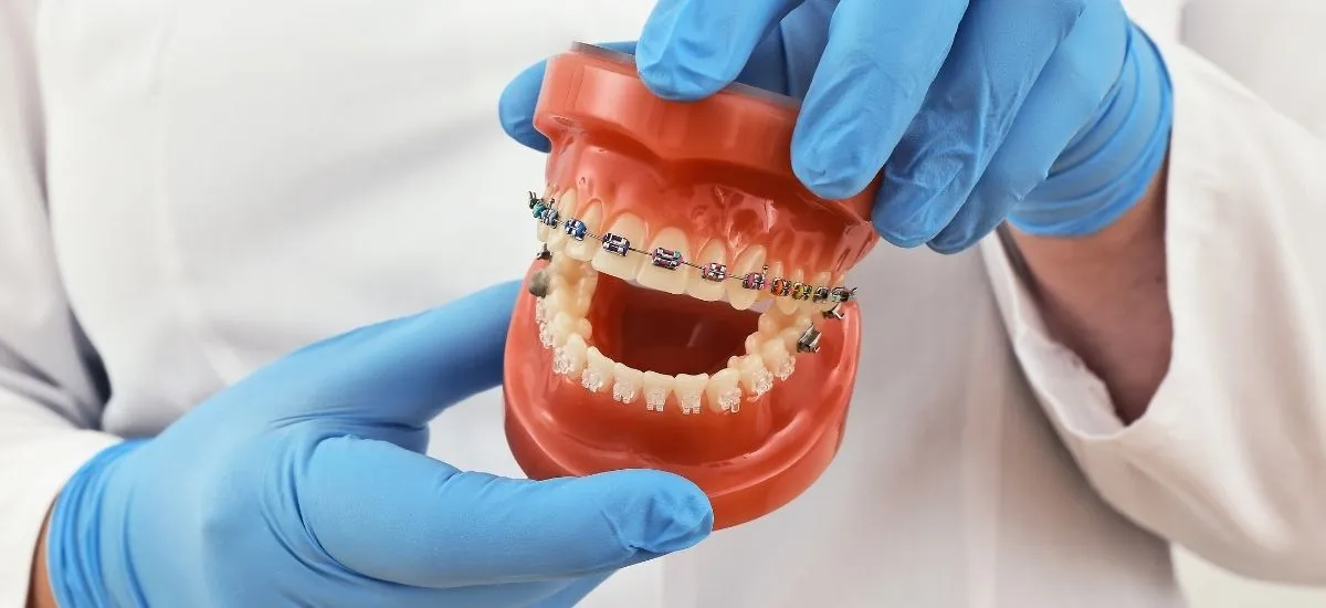 Modelo dental con brackets metálicos durante un tratamiento de ortodoncia