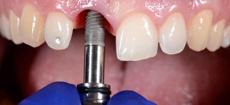 Colocación de un implante dental en un diente anterior