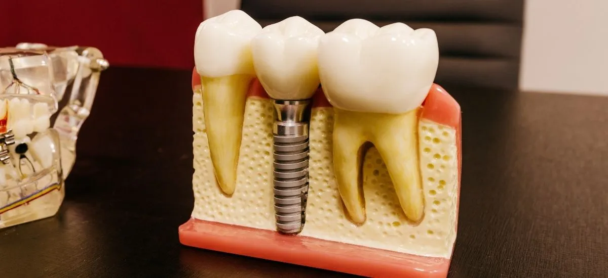 Modelo dental con un implante colocado en el hueso y una corona entre dos dientes naturales.